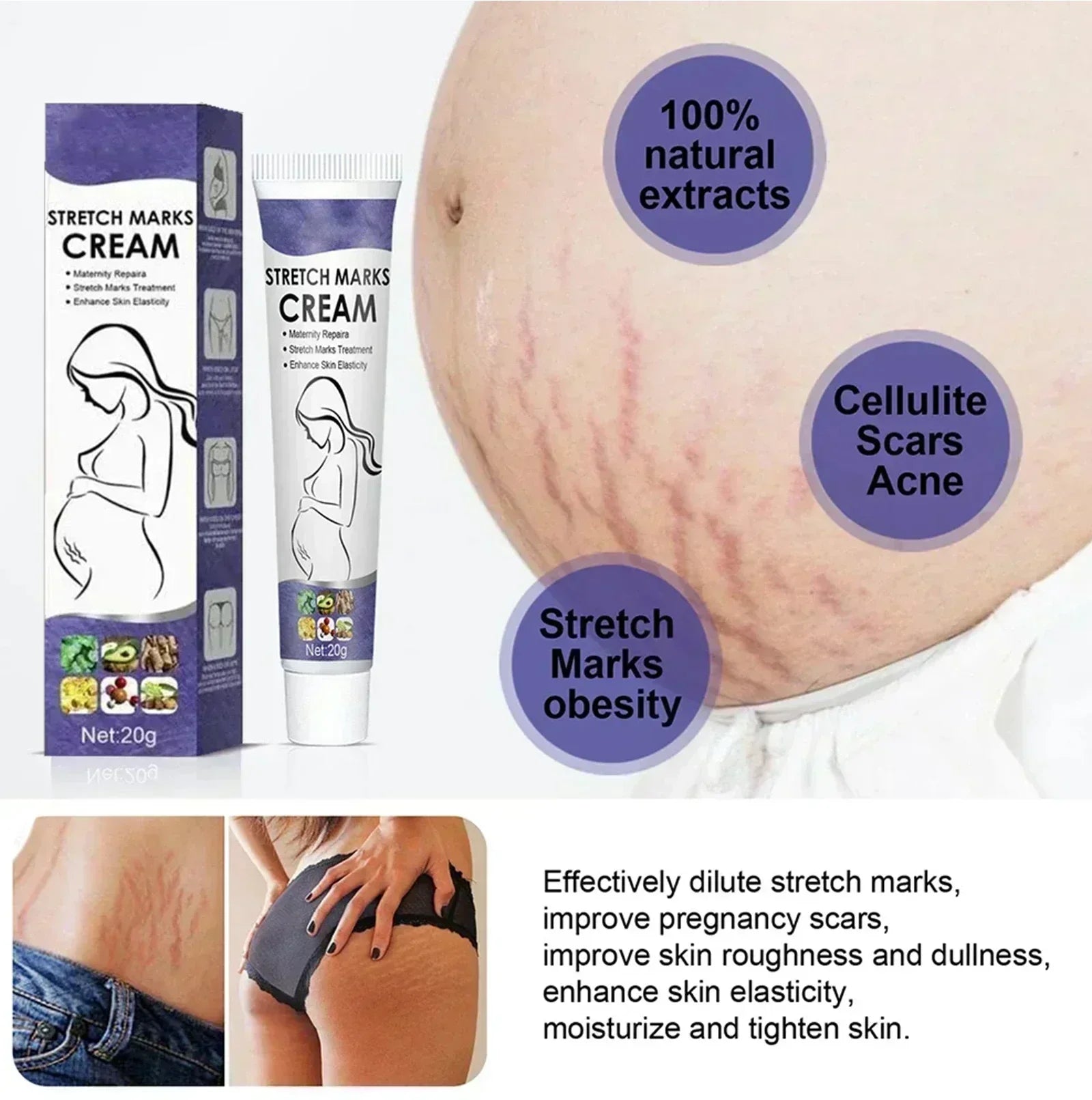Stretch Mark Removal Cream Permanently Removes Stretch Marks Rejuvenates Skin Stretch Mark Removal Cream